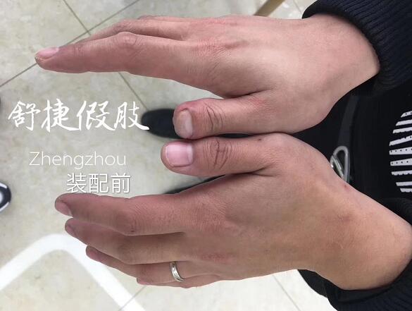 假肢价格
